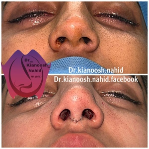 rhinoplasty-before-after-6